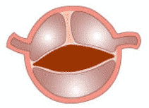 picture bicuspid aortic valve