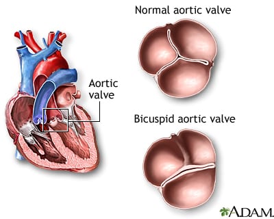 heart disease life insurance