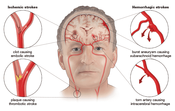 picture of stroke examples in brain