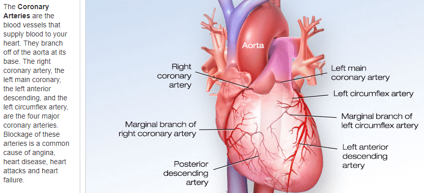 picture of coronary arteries with description of blockages